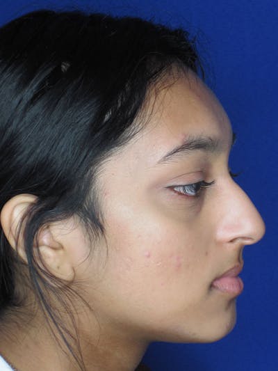 Rhinoplasty Before & After Gallery - Patient 121696020 - Image 1