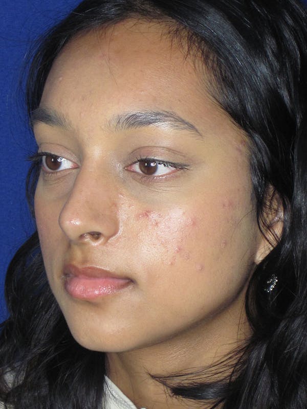 Rhinoplasty Before & After Gallery - Patient 121696020 - Image 4
