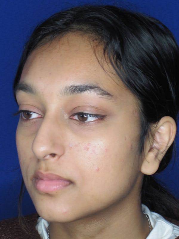 Rhinoplasty Before & After Gallery - Patient 121696020 - Image 3