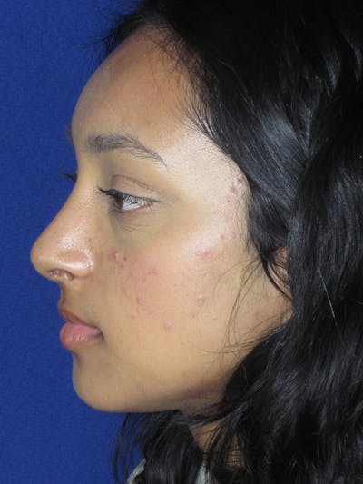 Rhinoplasty Before & After Gallery - Patient 121696020 - Image 6