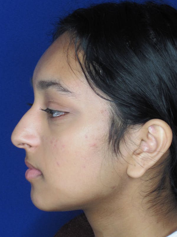 Rhinoplasty Before & After Gallery - Patient 121696020 - Image 5