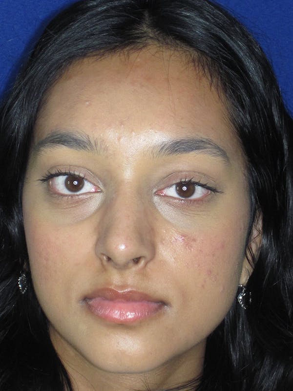 Rhinoplasty Before & After Gallery - Patient 121696020 - Image 8