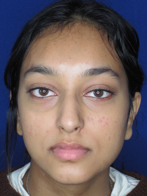 Rhinoplasty Before & After Gallery - Patient 121696020 - Image 7
