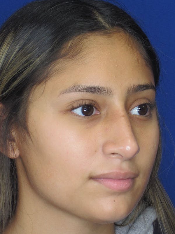 Rhinoplasty Before & After Gallery - Patient 121696093 - Image 2