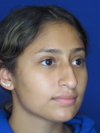 Rhinoplasty Before & After Gallery - Patient 121696093 - Image 1