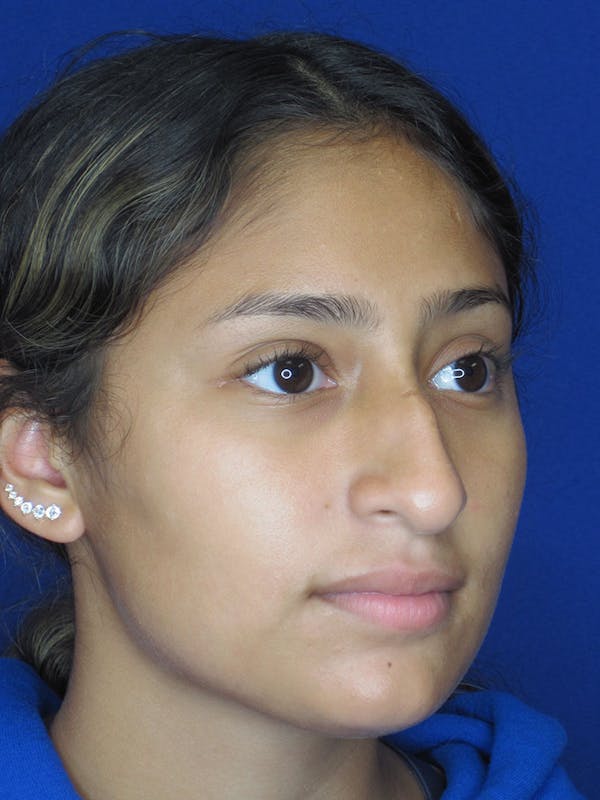 Rhinoplasty Before & After Gallery - Patient 121696093 - Image 1