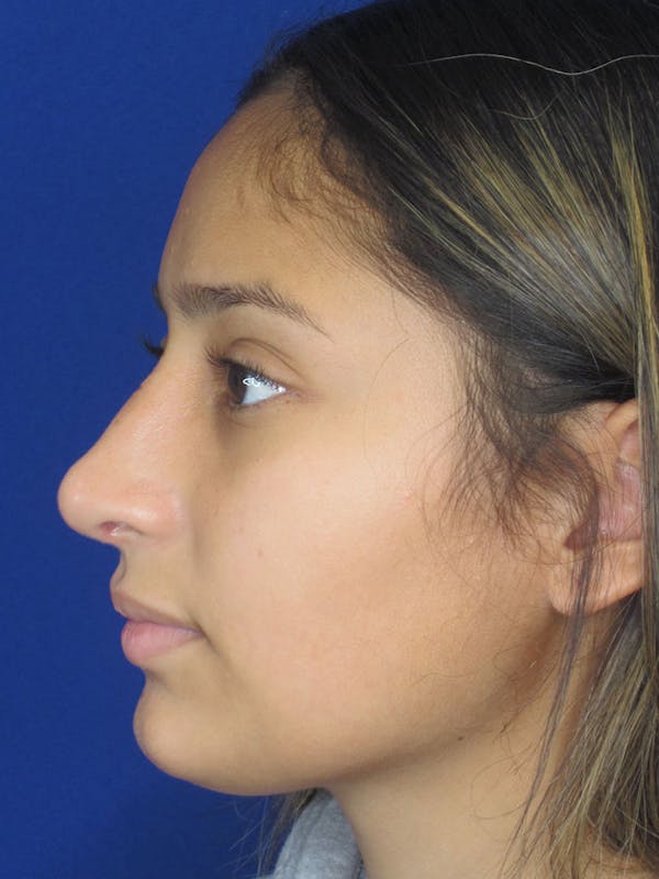 Rhinoplasty Before & After Gallery - Patient 121696093 - Image 4