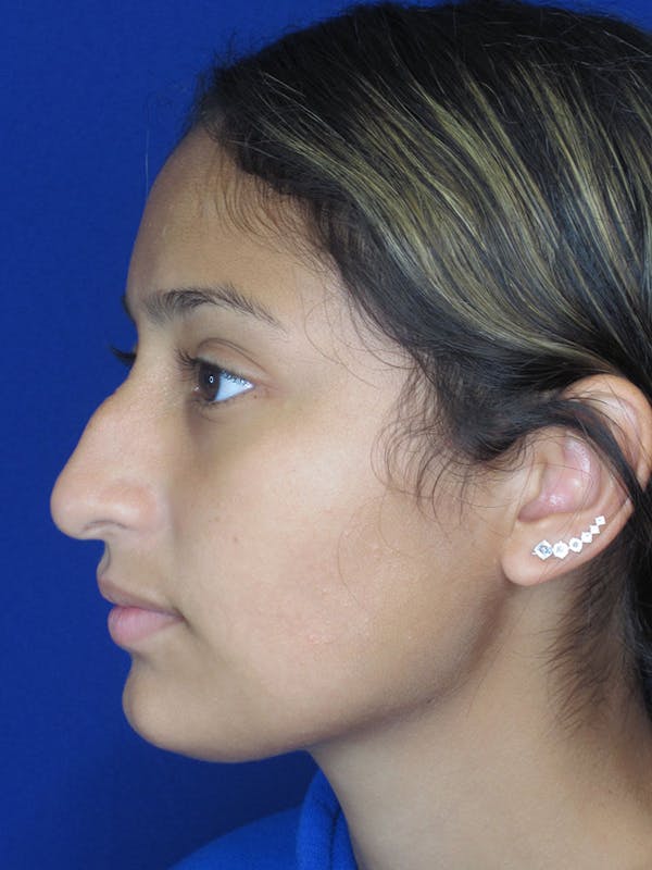 Rhinoplasty Before & After Gallery - Patient 121696093 - Image 3