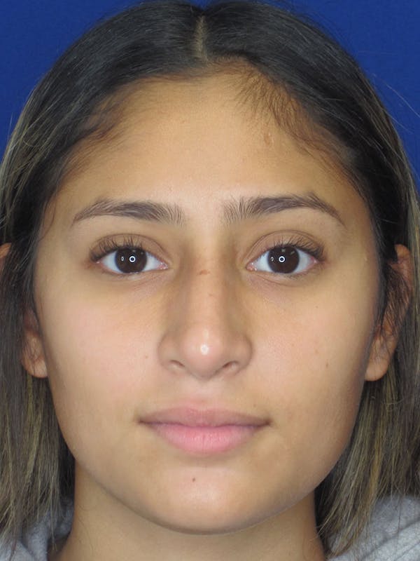 Rhinoplasty Before & After Gallery - Patient 121696093 - Image 6