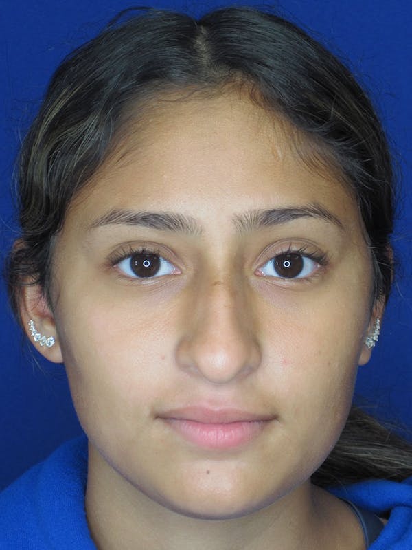 Rhinoplasty Before & After Gallery - Patient 121696093 - Image 5
