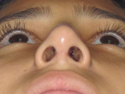 Rhinoplasty Before & After Gallery - Patient 121696093 - Image 8