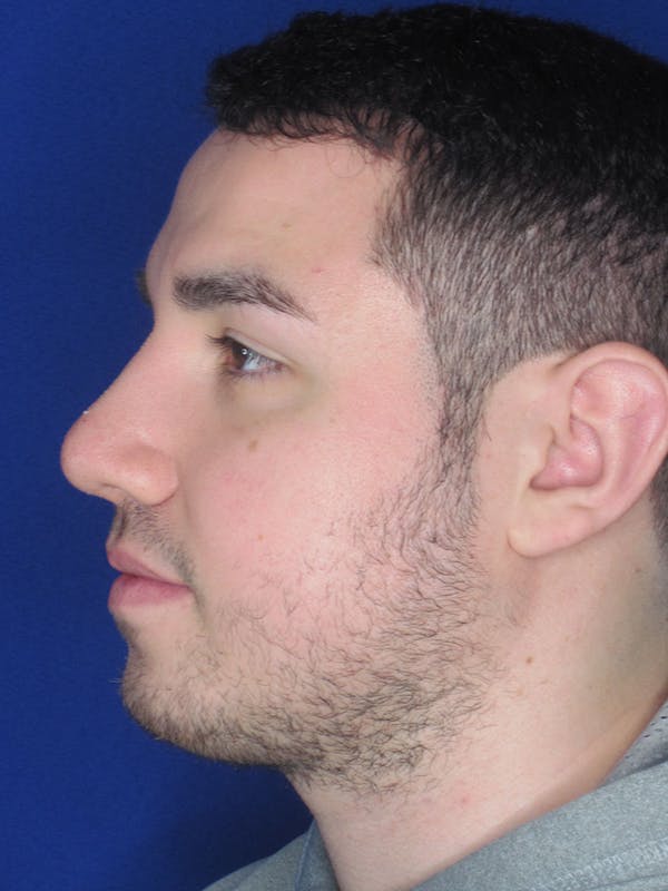Rhinoplasty Before & After Gallery - Patient 121696094 - Image 2
