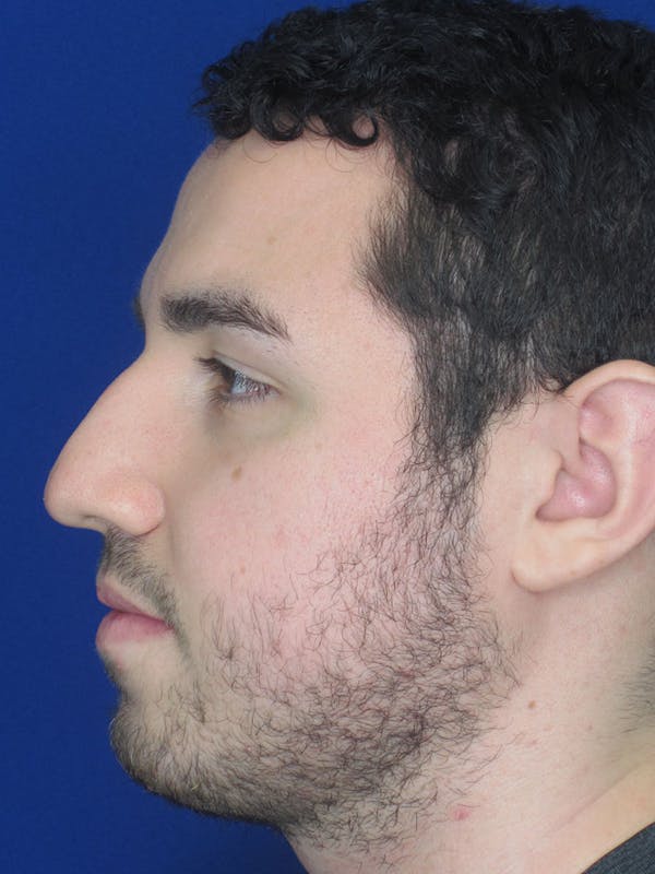 Rhinoplasty Before & After Gallery - Patient 121696094 - Image 1