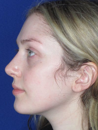 Rhinoplasty Before & After Gallery - Patient 121696095 - Image 2
