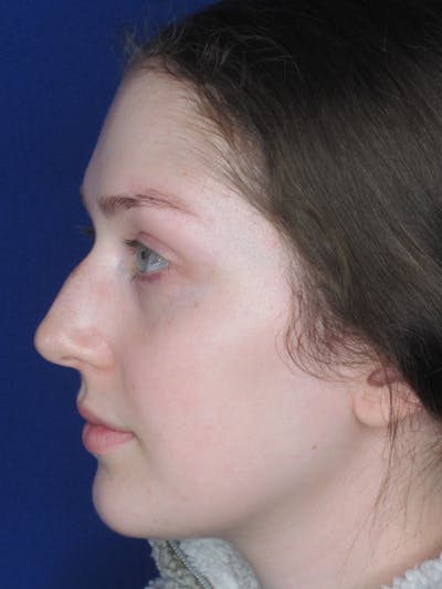 Rhinoplasty Before & After Gallery - Patient 121696095 - Image 1