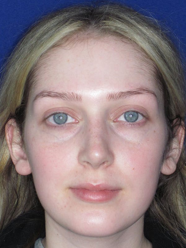 Rhinoplasty Before & After Gallery - Patient 121696095 - Image 4