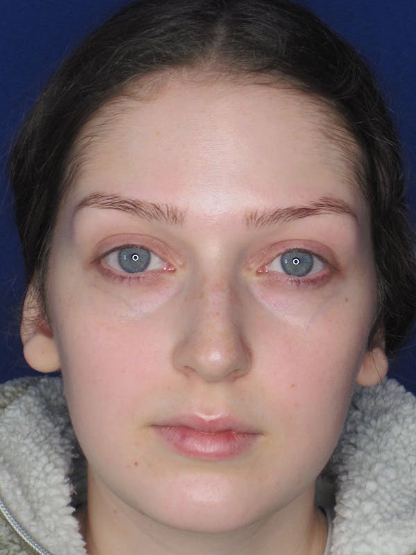 Rhinoplasty Before & After Gallery - Patient 121696095 - Image 3