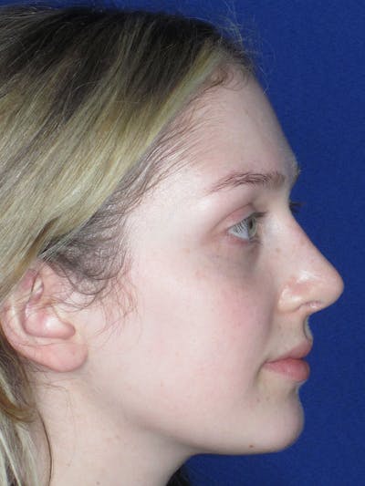 Rhinoplasty Before & After Gallery - Patient 121696095 - Image 6