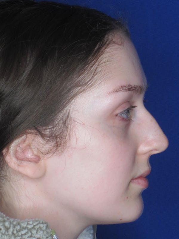 Rhinoplasty Before & After Gallery - Patient 121696095 - Image 5