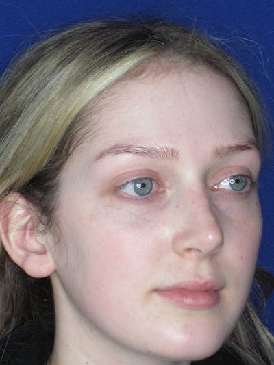 Rhinoplasty Before & After Gallery - Patient 121696095 - Image 8