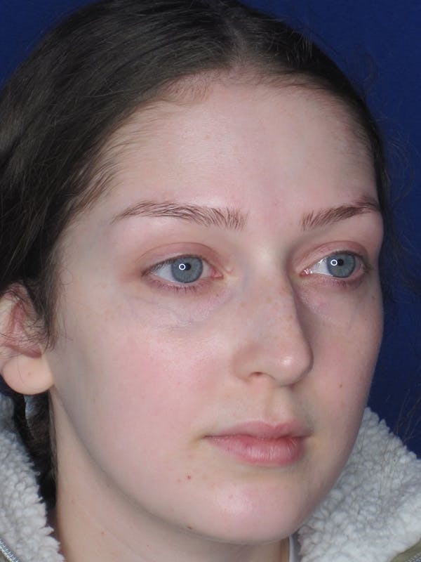 Rhinoplasty Before & After Gallery - Patient 121696095 - Image 7