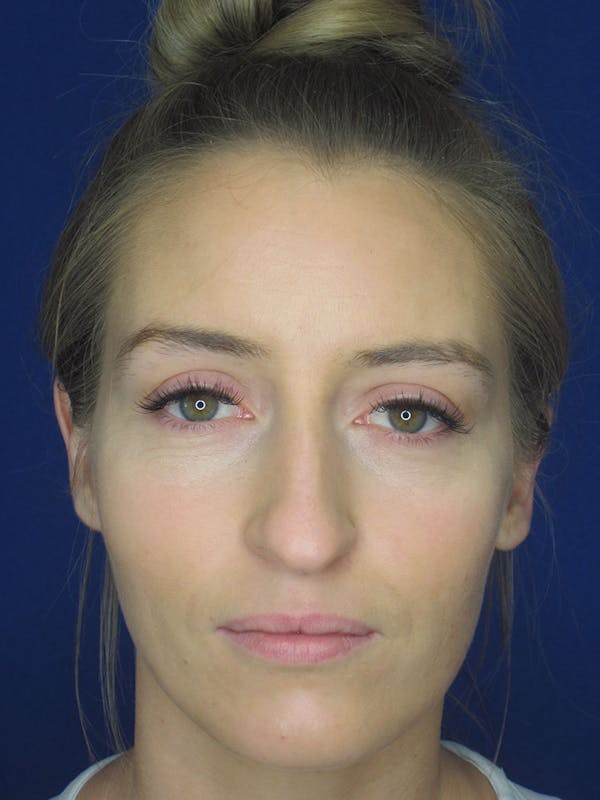 Rhinoplasty Before & After Gallery - Patient 121696096 - Image 1