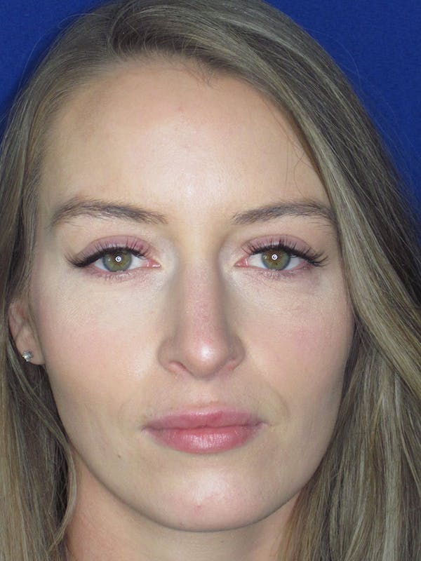Rhinoplasty Before & After Gallery - Patient 121696096 - Image 2