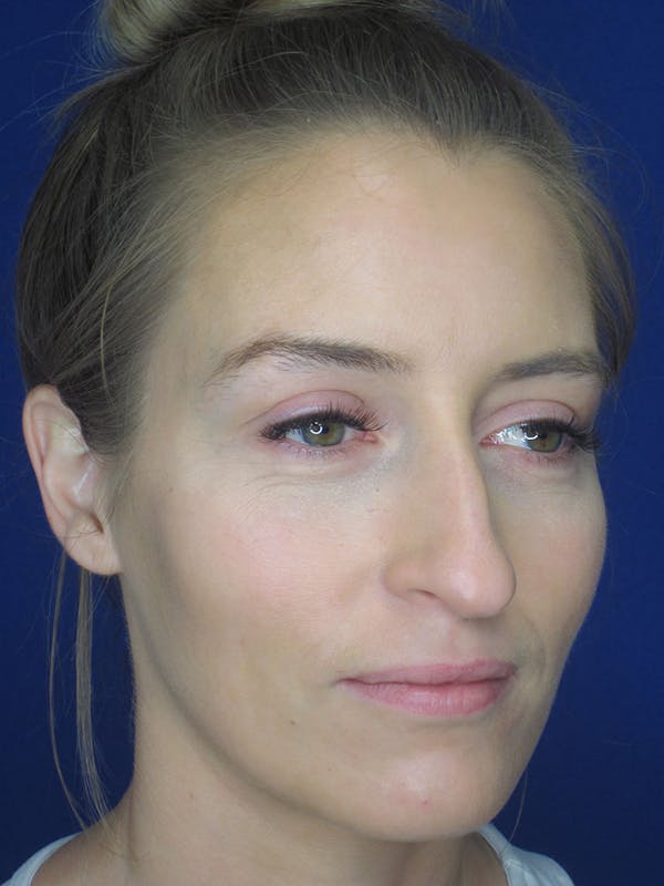 Rhinoplasty Before & After Gallery - Patient 121696096 - Image 3