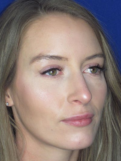 Rhinoplasty Before & After Gallery - Patient 121696096 - Image 4
