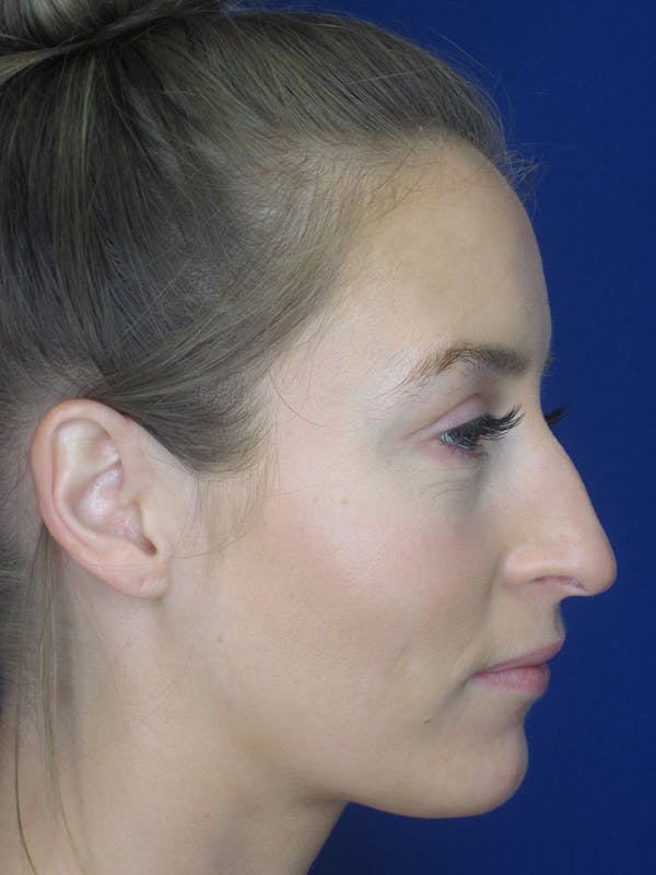 Rhinoplasty Before & After Gallery - Patient 121696096 - Image 5