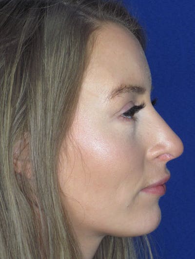 Rhinoplasty Before & After Gallery - Patient 121696096 - Image 6