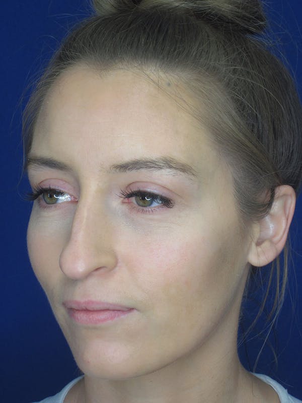 Rhinoplasty Before & After Gallery - Patient 121696096 - Image 7