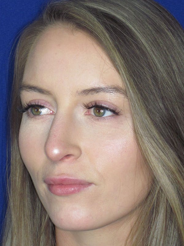 Rhinoplasty Before & After Gallery - Patient 121696096 - Image 8