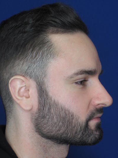 Rhinoplasty Before & After Gallery - Patient 121696097 - Image 2