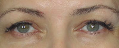 Blepharoplasty Before & After Gallery - Patient 121696103 - Image 1