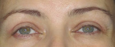 Blepharoplasty Before & After Gallery - Patient 121696103 - Image 2