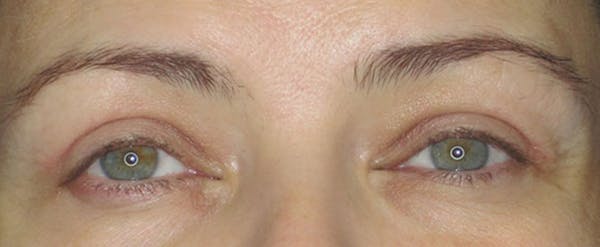 Blepharoplasty Before & After Gallery - Patient 121696103 - Image 2