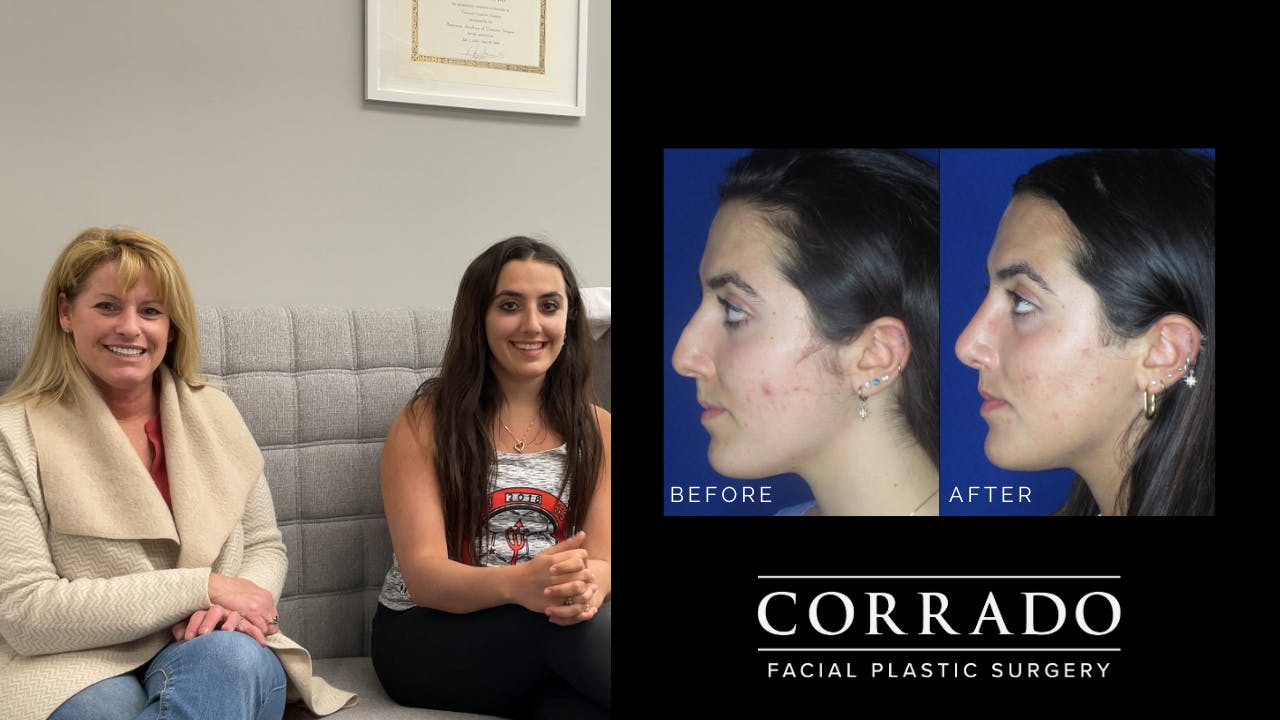 Revision Rhinoplasty Before and After