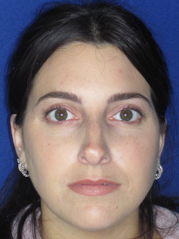 Rhinoplasty Before & After Gallery - Patient 165413233 - Image 5
