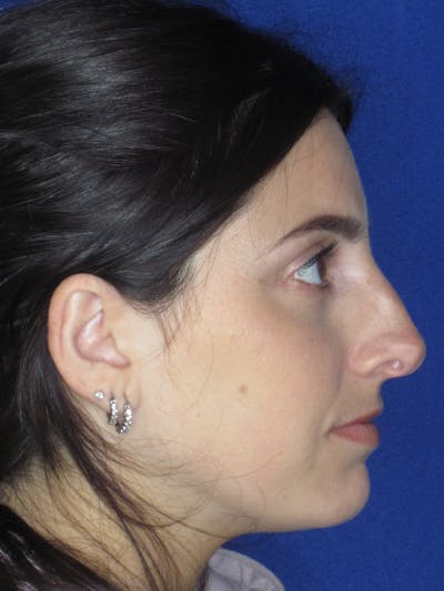 Rhinoplasty Before & After Gallery - Patient 165413233 - Image 1