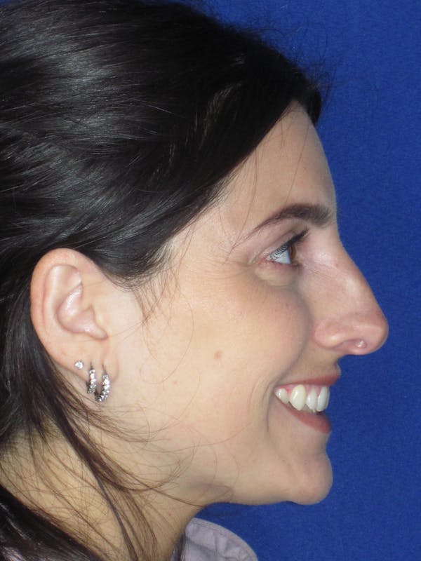 Rhinoplasty Before & After Gallery - Patient 165413233 - Image 7