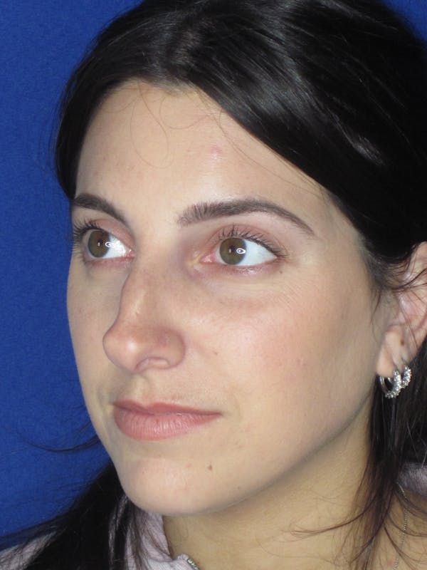 Rhinoplasty Before & After Gallery - Patient 165413233 - Image 3
