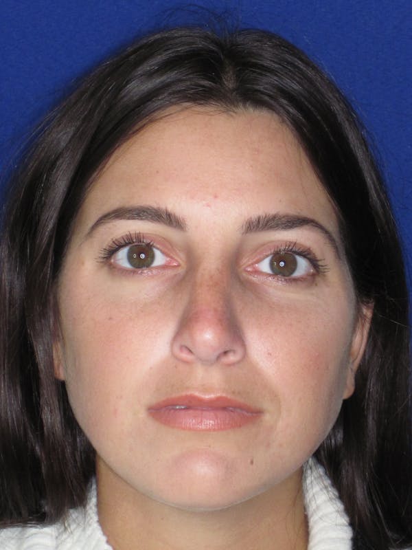 Rhinoplasty Before & After Gallery - Patient 165413233 - Image 6