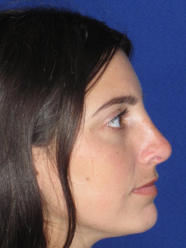 Rhinoplasty Before & After Gallery - Patient 165413233 - Image 2