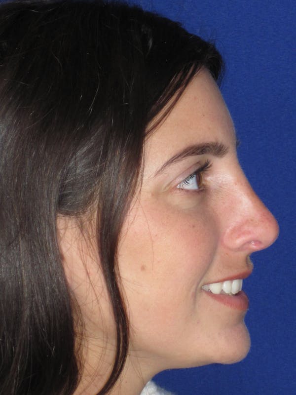 Rhinoplasty Before & After Gallery - Patient 165413233 - Image 8