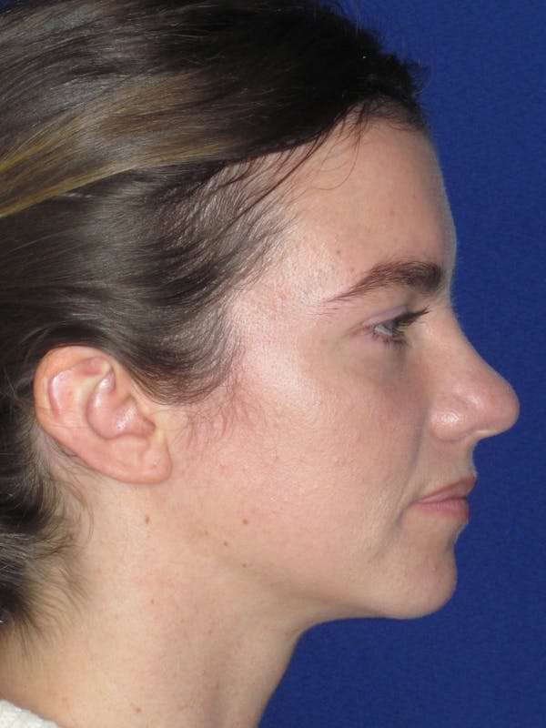 Rhinoplasty Before & After Gallery - Patient 165413238 - Image 7