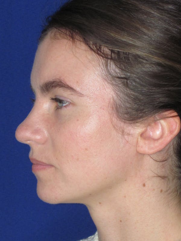 Rhinoplasty Before & After Gallery - Patient 165413238 - Image 11