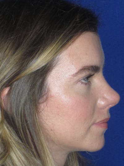 Rhinoplasty Before & After Gallery - Patient 165413238 - Image 8
