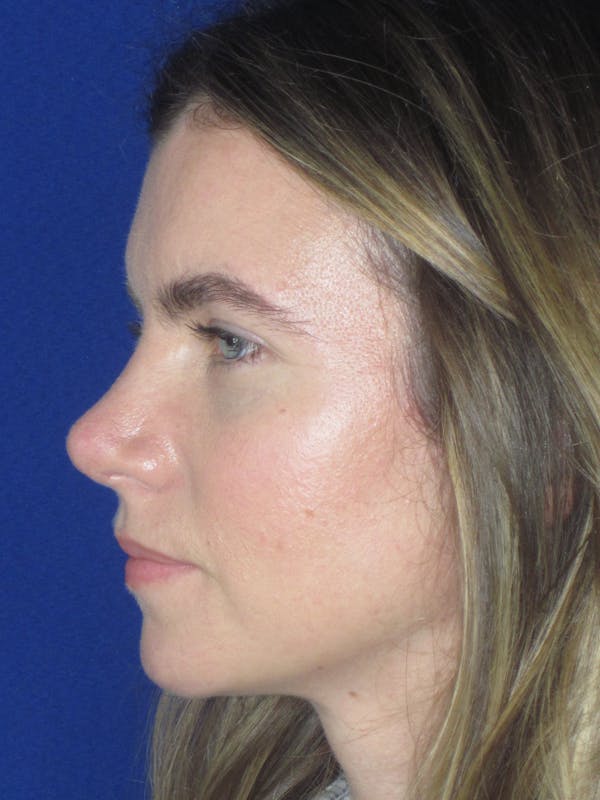Rhinoplasty Before & After Gallery - Patient 165413238 - Image 12