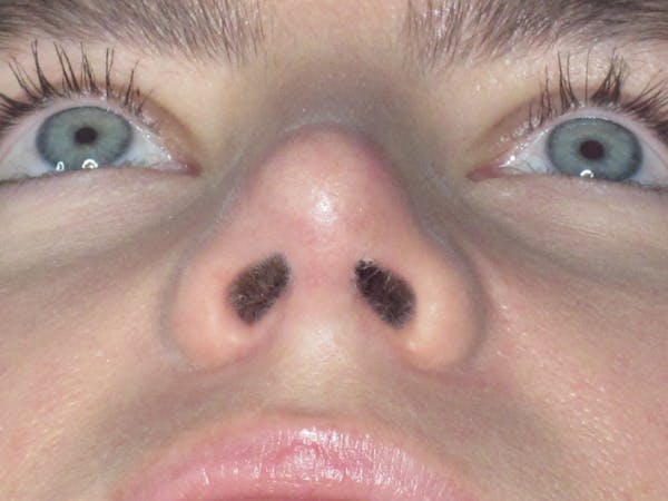 Rhinoplasty Before & After Gallery - Patient 165413238 - Image 13